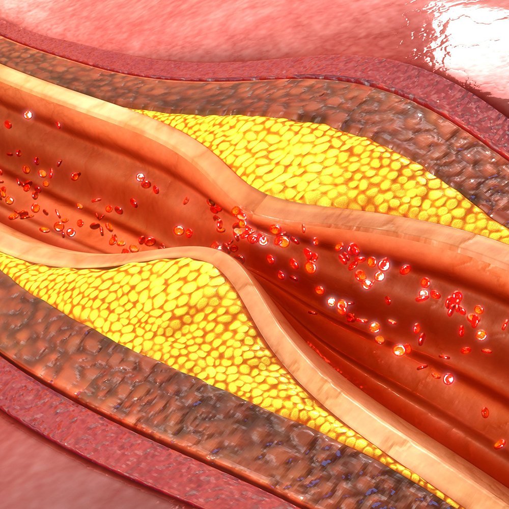 Carotid Artery Disease