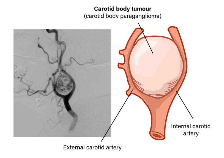 Carotid Body tumor