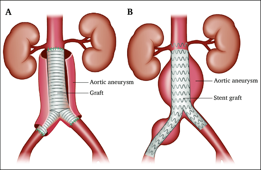 Aortic aneurysm treatment in Amman Jordan