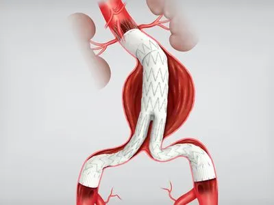 Endovascular aortic repair EVAR