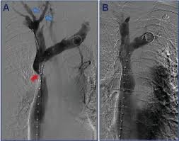 متلازمة الوريد الأجوف العلوي لدى مريضة شابة على غسيل الكلى