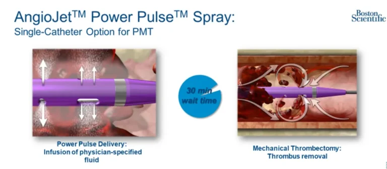 Severe Deep Vein Thrombosis (AR)