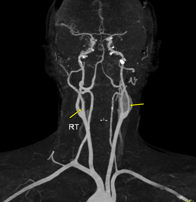 فهم أورام الجسم السباتي: الأعراض، التشخيص، والعلاج