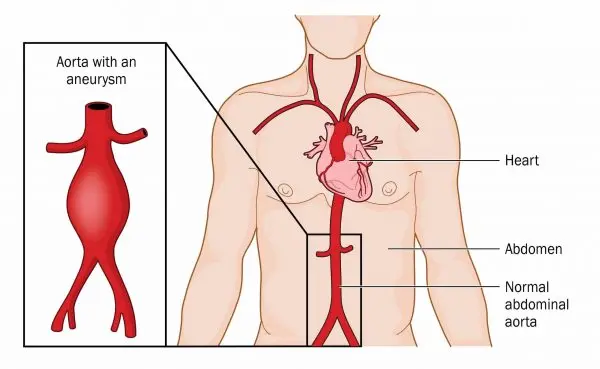 الشريان الابهر