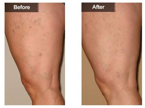 أحدث طرق علاج الدوالي في الأردن