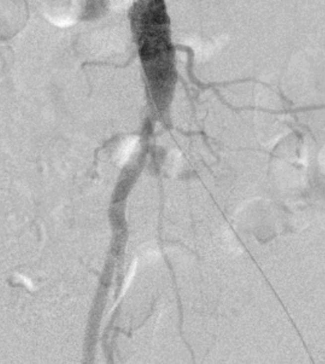 Peripheral angioplasty by Dr Omar Hamdallah